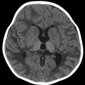 CAT scan of a Tay Sachs sufferer's brain. No joke.
